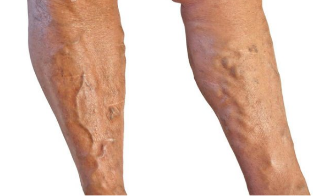Θεραπεία των κιρσών στα πόδια