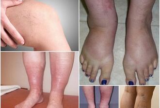 Φωτογραφίες εκδηλώσεων κινεζικών φλεβών στα πόδια