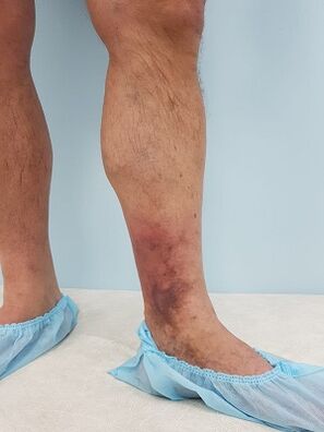 επιπλοκές από κιρσούς στους άνδρες