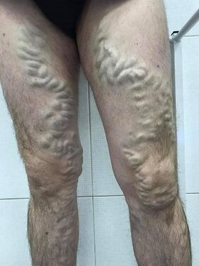 παραμελημένοι ανδρικοί κιρσοί