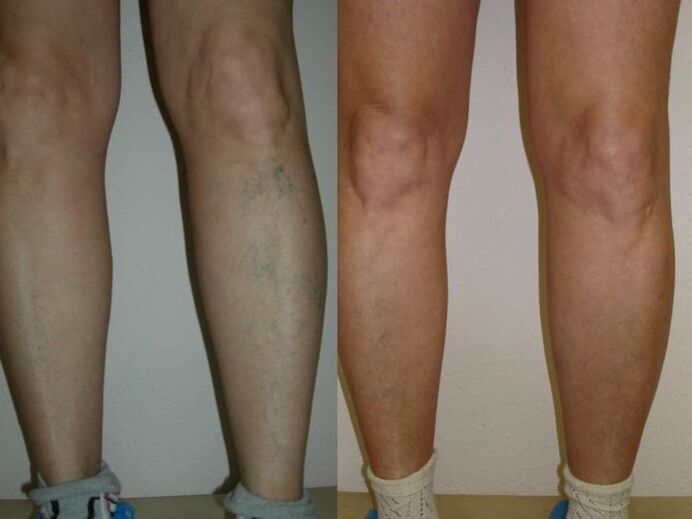 πόδια πριν και μετά τη θεραπεία των κιρσών με λέιζερ