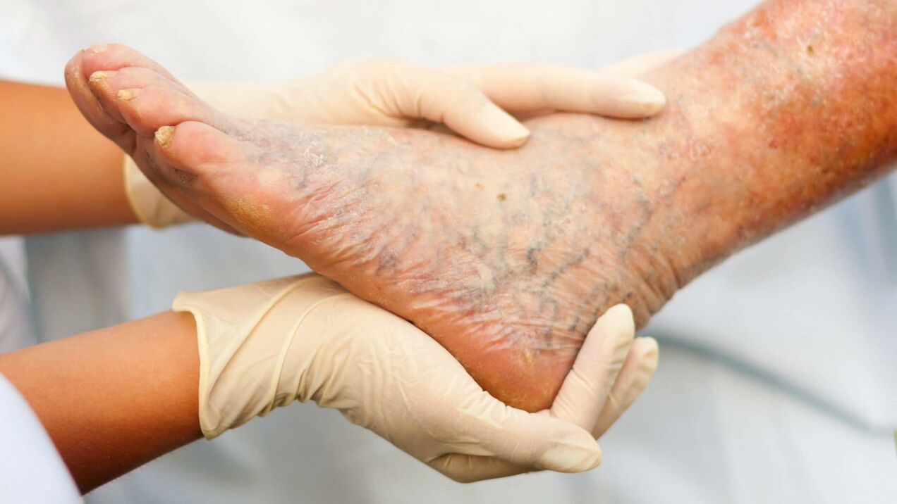 Ο φλεβολόγος ασχολείται με την αντιμετώπιση των κιρσών στα πόδια