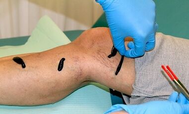 Hirudotherapy για κιρσοί φλέβες