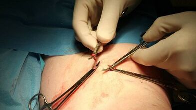Flebectomy για κιρσοί φλεβές