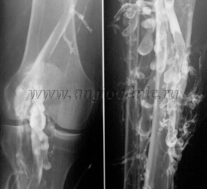 Σάρωση με υπερήχους